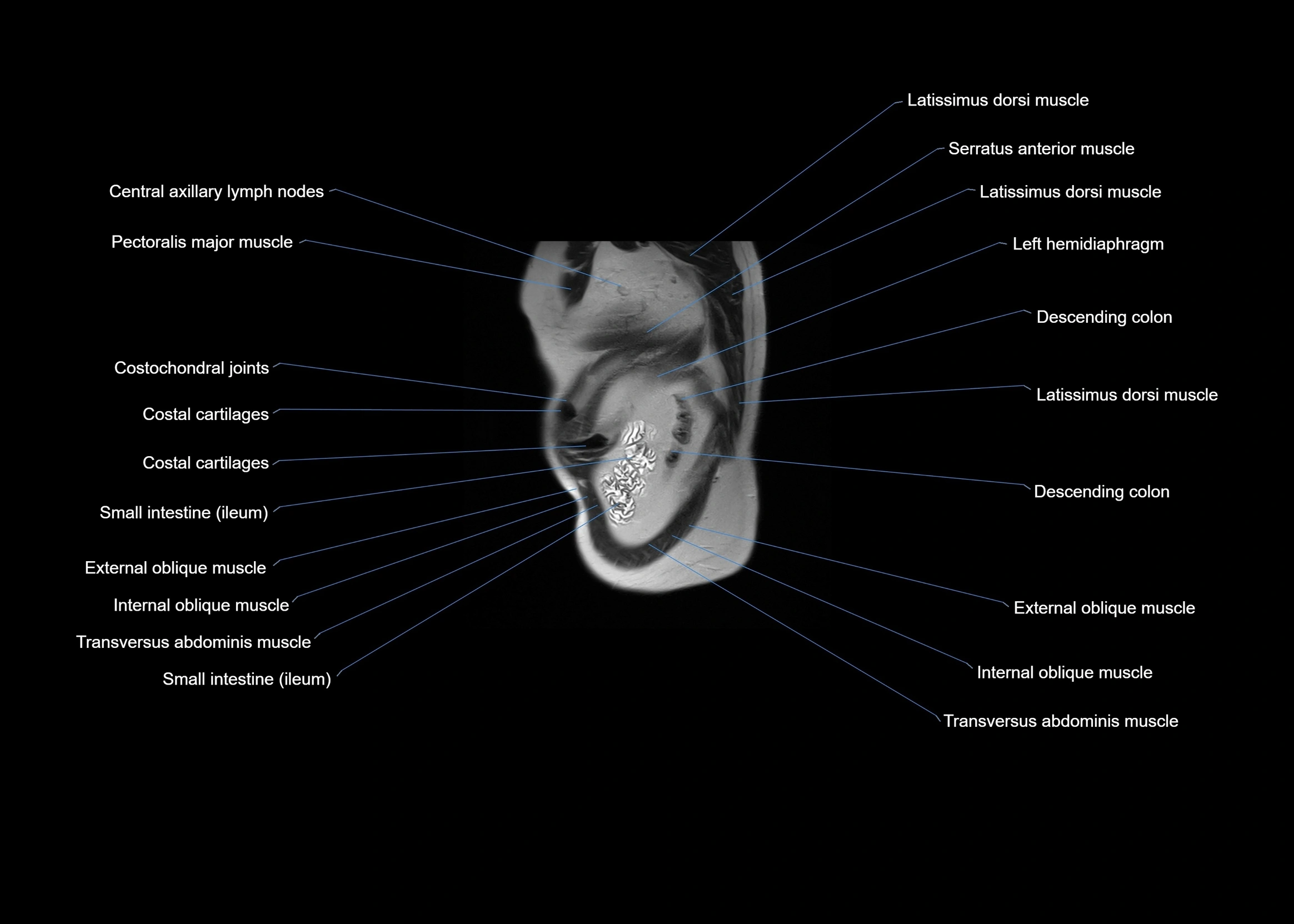 MRI abdomen sagittal cross sectional anatomy  radiology  image-img-00001-00064.webp